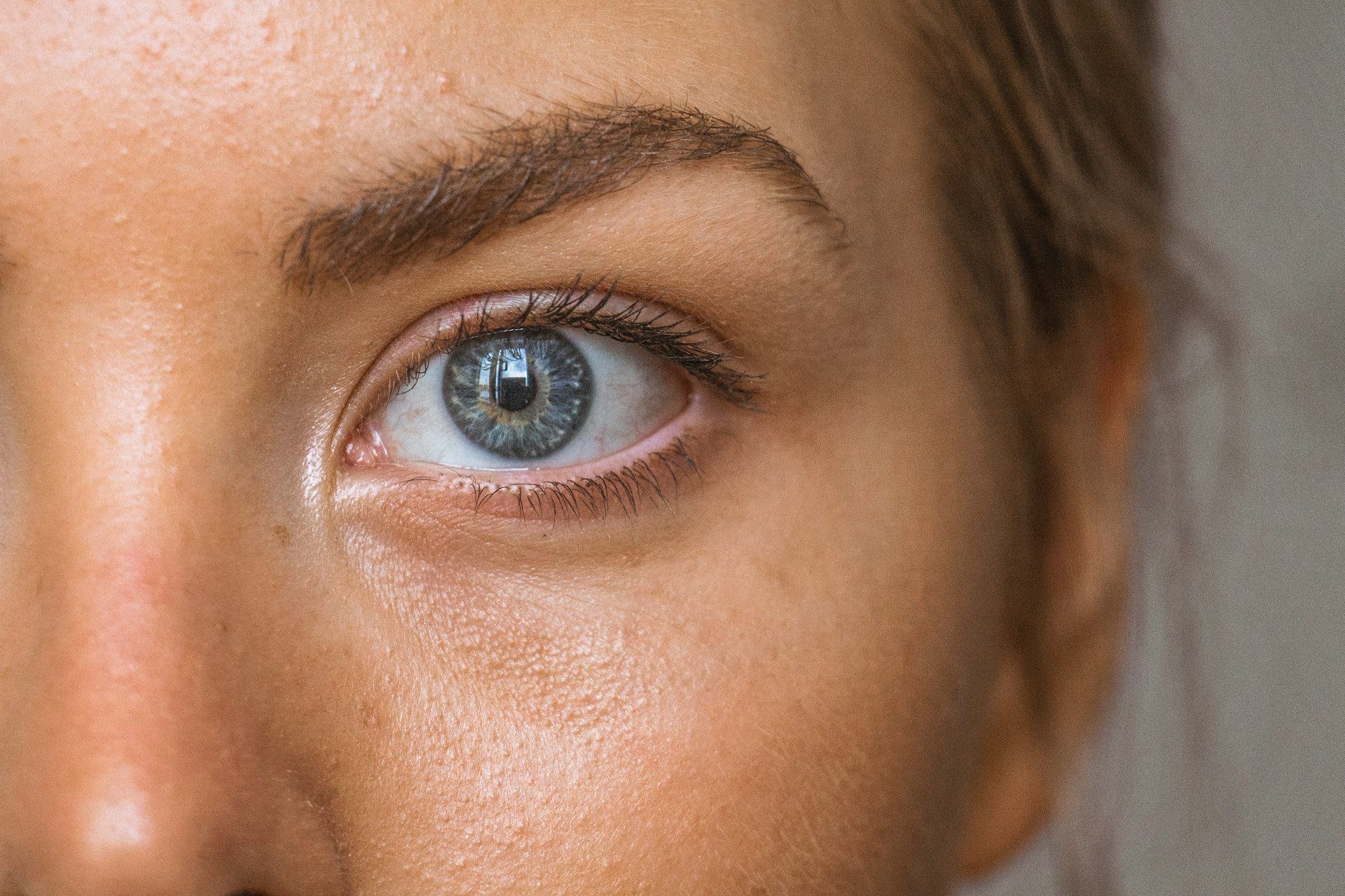 So erkennst du hormonelle Akne und bekämpfst sie effektiv